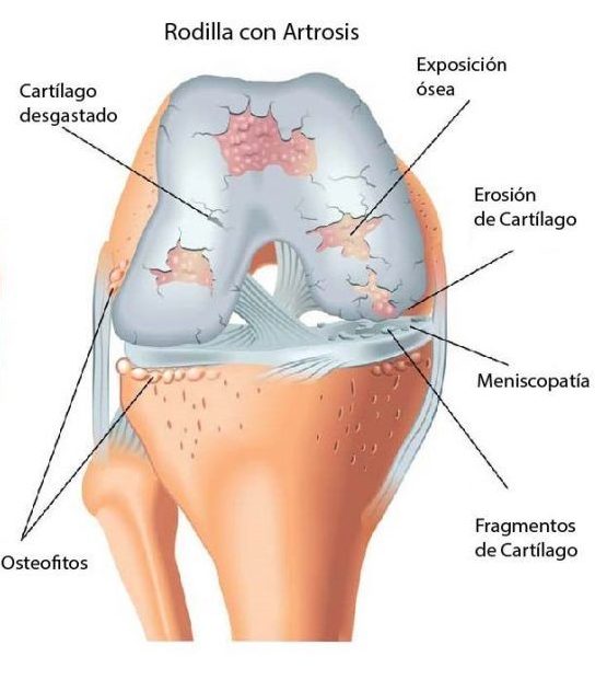 Cuándo operar la artrosis de rodilla?